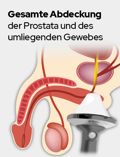 Behandlung einer CPPS mittels ESWT