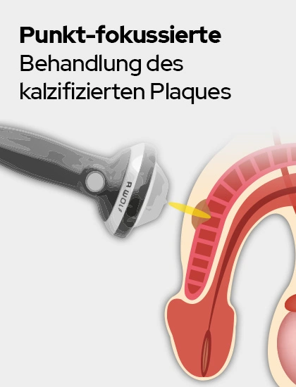 ESWT Behandlung einer IPP